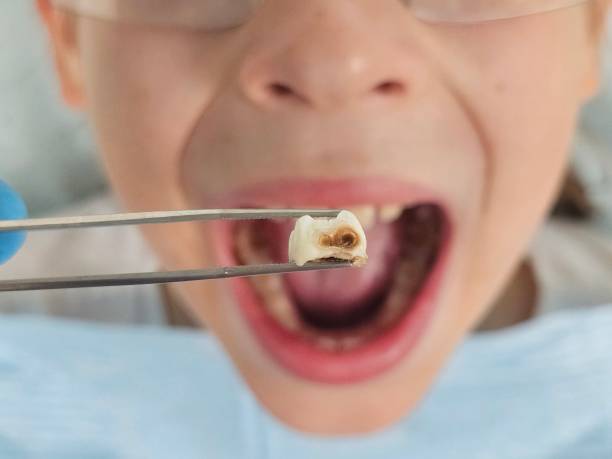 Best Emergency Dentist for Knocked-Out Tooth in Parkston, SD