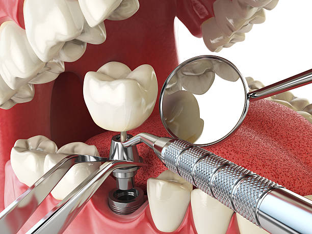Best Emergency Dentist for Lost Fillings or Crowns in Parkston, SD